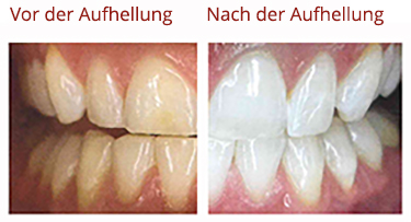 Ergebnis professionelle Zahnaufhellung